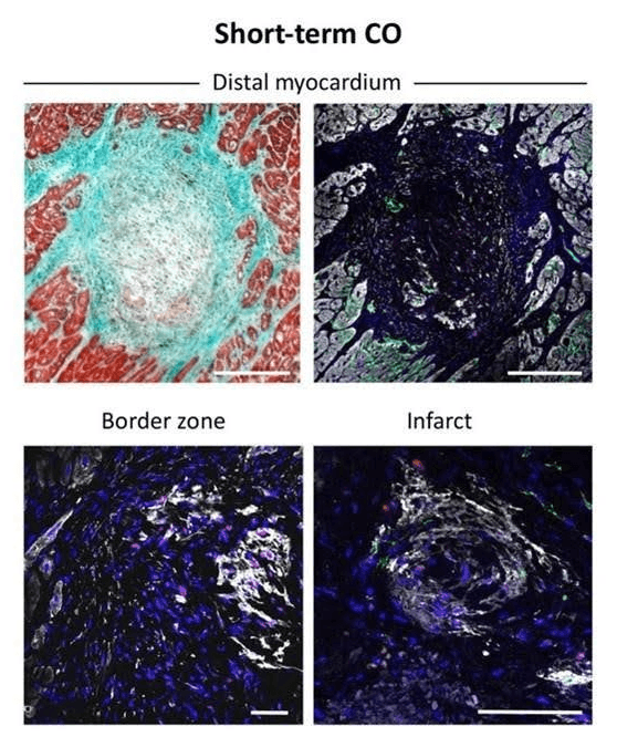Distal myocardium — histology