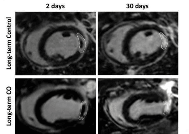 MRI — 2 days vs 30 days